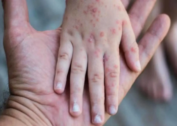 En México hay actualmente 362 casos de sarampión; Ssa reporta un deceso