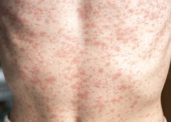 Suben a mil 520 los casos de sarampión en México: ¿cuáles son los estados más afectados?