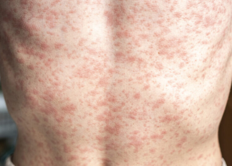 A person's body is covered in a rash, measles.
