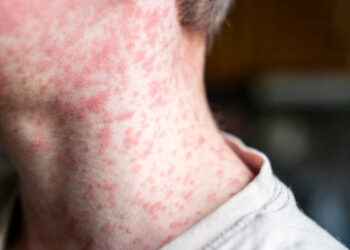 Reportan mil 789 casos y cinco muertes por sarampión en México: estos son los estados más afectados